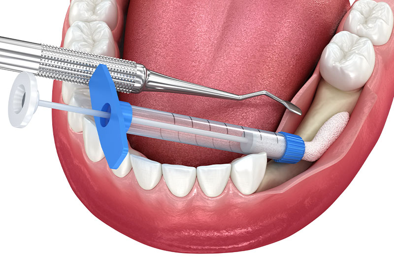 Bone Grafting in Cincinnati