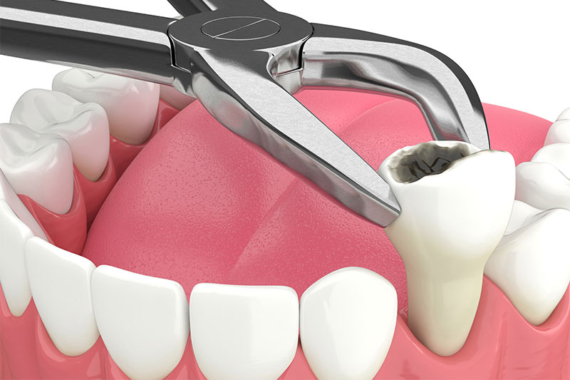 Tooth Extraction in Cincinnati