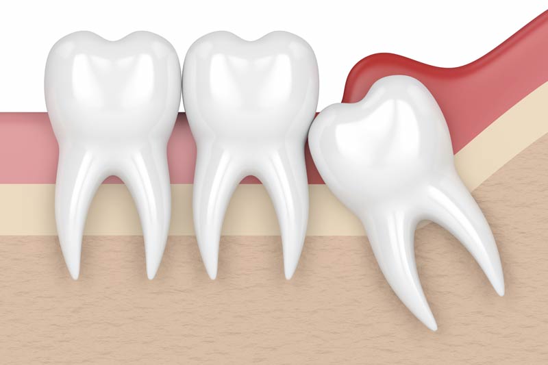 Wisdom Tooth Removal in Cincinnati